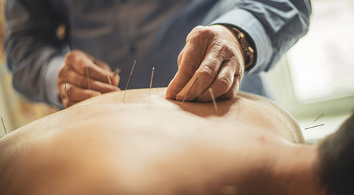  Close-up view of a man lying face down and being treated by the acupuncturist. He's applying the needle on man's back area